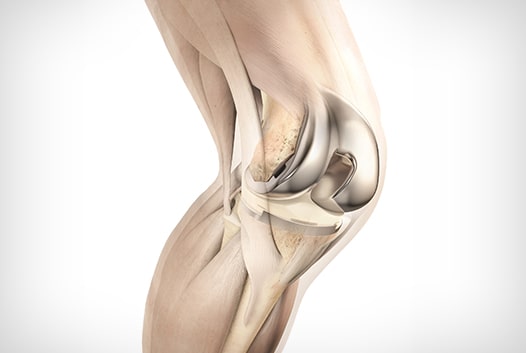 Revision Knee Replacement